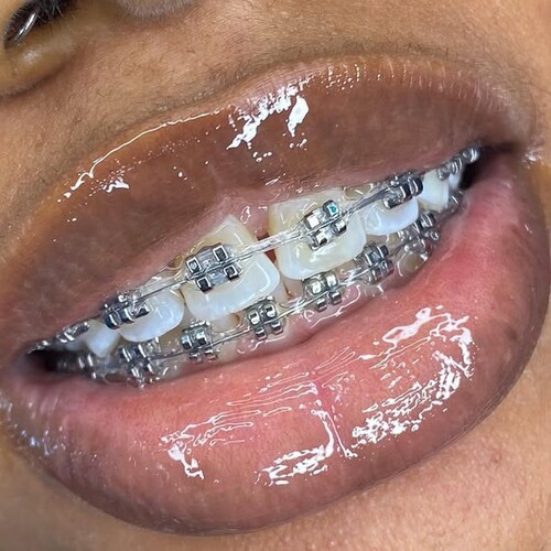 Close-up of braces on teeth