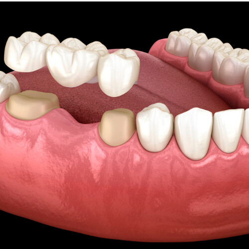 3D rendering of dental crown fitting