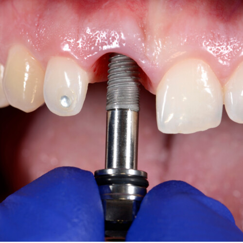 Titanium dental implant placement