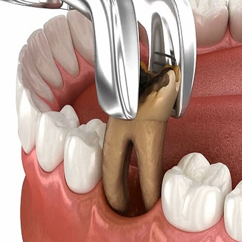 3D illustration of tooth extraction