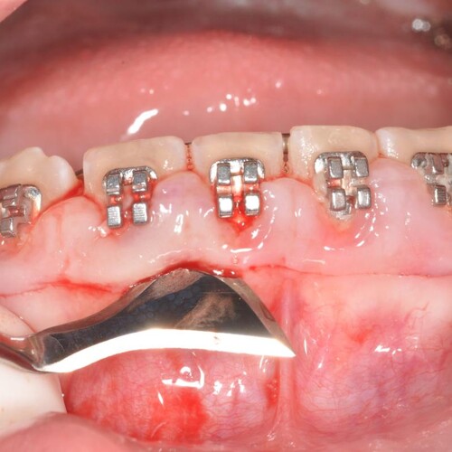 Periodontal gum treatment