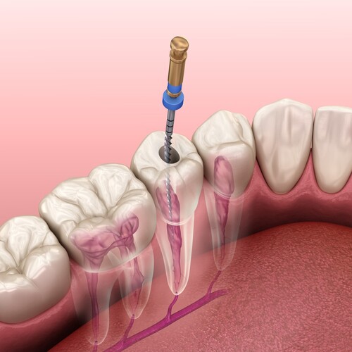 3D illustration of root canal procedure